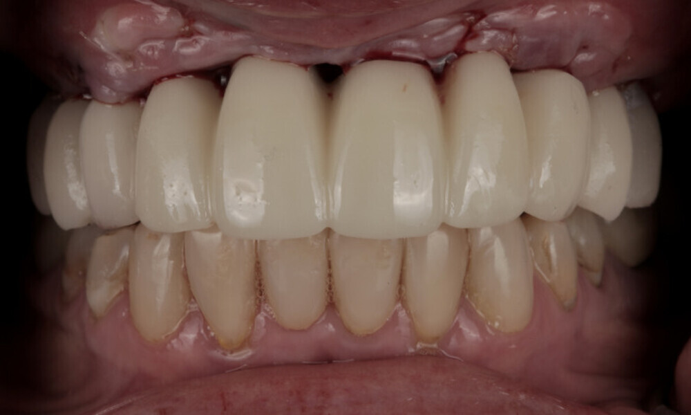 Fig. 16b: Frontal view with retracted lips.