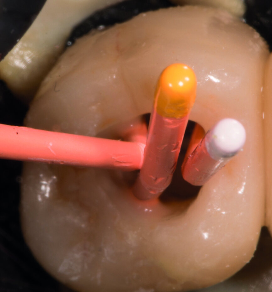 Fig. 9 : Maîtres cônes mis en place dans le canal. 