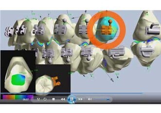 eXceed Precision Bracket Placement Solution eXceed Precision Bracket Placement Solution