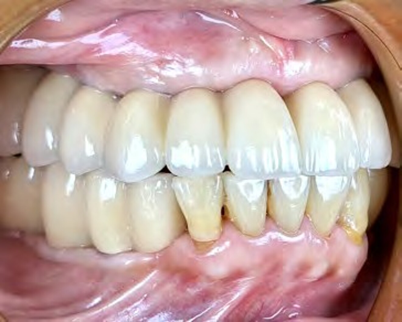 Fig. 3f: Right lateral intraoral view demonstrating stable posterior occlusal  contacts following definitive prosthesis insertion.