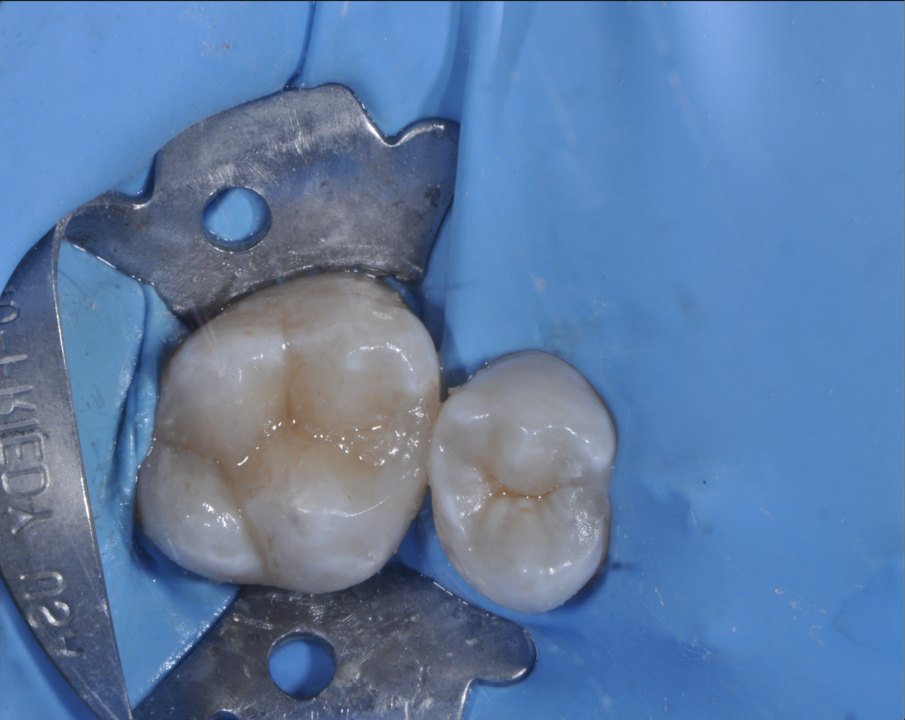 Fig. 6 - Foto occlusale intraoperatoria del restauro diretto finalizzato.