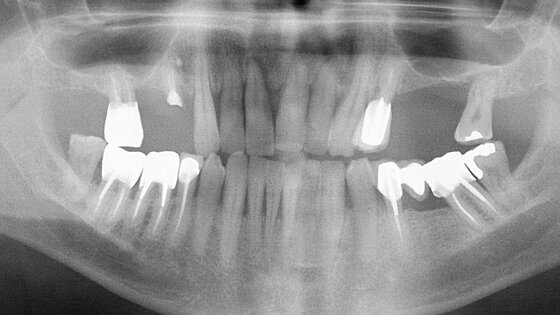 Apport des technologies numériques et de la CFAO en prothèse implantaire vissée : deux cas cliniques