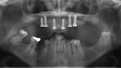 Fáze před ošetřením a význam stabilní parodontální situace