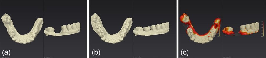 Fig. 28_a), b): File STL pre-operatori e a 2 anni e 7 mesi post-operatori esportati nel software DTX Studio; c) i due file STL sovrapposti per ulteriori confronti.