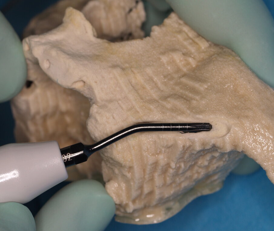 Fig. 3 - La ridotta lunghezza e la forma appropriata rendono la preparazione estremamente precisa.