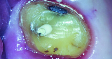 Minimally invasive root canal shaping—A new protocol