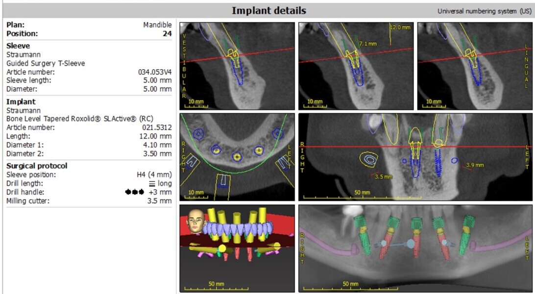 Fig. 13: Mandibular surgical treatment planning using coDiagnostiX.