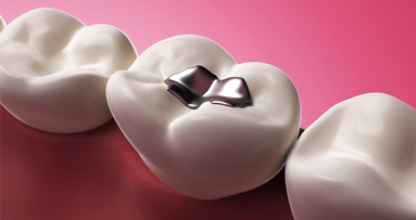 EU akzeptiert Amalgam – aber …