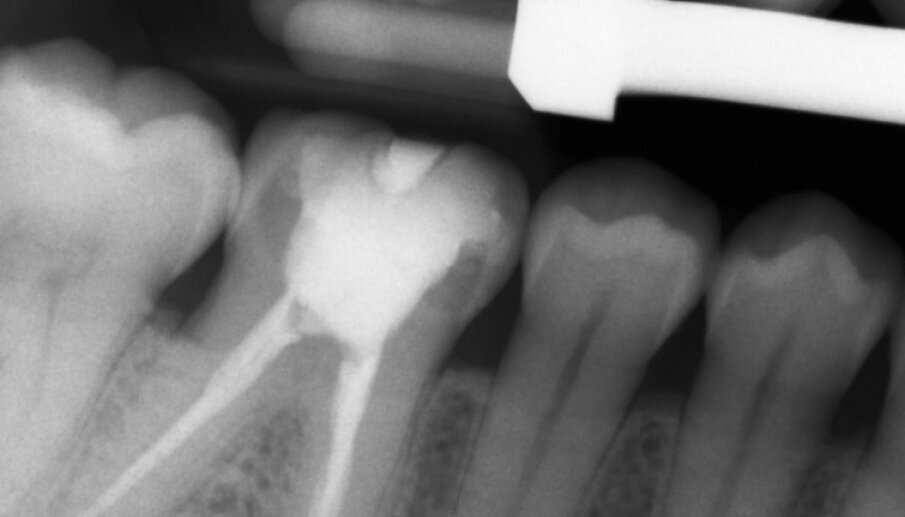Figs. 13a & b: Radiographic control images before and after the treatment.