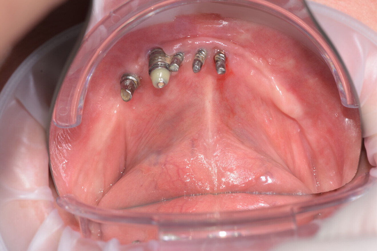 Fig. 1: Situation in the mandible before treatment.