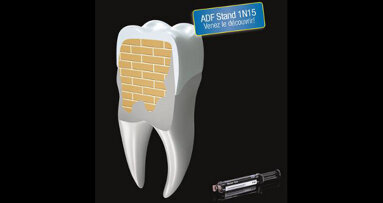 Nouvelle génération de matériaux pour reconstitution de moignons.
