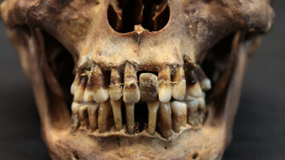 La dentition de la dépouille d'Anne d'Alègre livre ses secrets grâce au Cone Beam