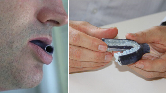 New 3-D mouthpiece may help thousands of sleep apnoea patients