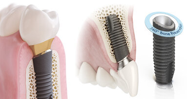 Astra Tech OsseoSpeed Profile EV ‒ L’impianto specificamente studiato per creste inclinate. Segue il profilo naturale.
