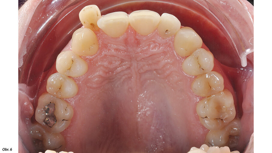Horní řezáky jsou mírně protrudované, dolní řezáky mírně retrudované.