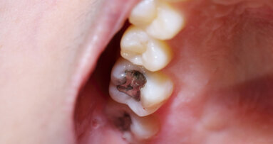 Dentalamalgam: Alternativen für Kinder und Schwangere