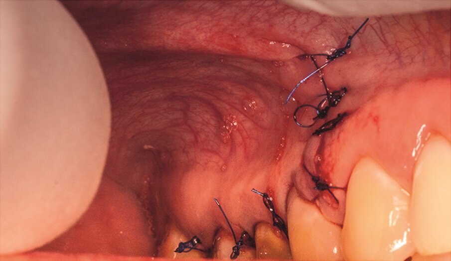Fig. 2l: Sutured flap.