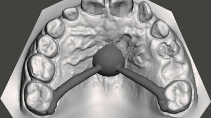 Ortodonzia intercettiva… oggi: viaggio dall’analogico al digitale