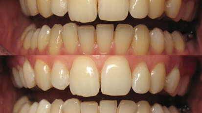 Ortodoncia y Blanqueamiento: La guinda del pastel Ortodoncia y Blanqueamiento: La guinda del pastel