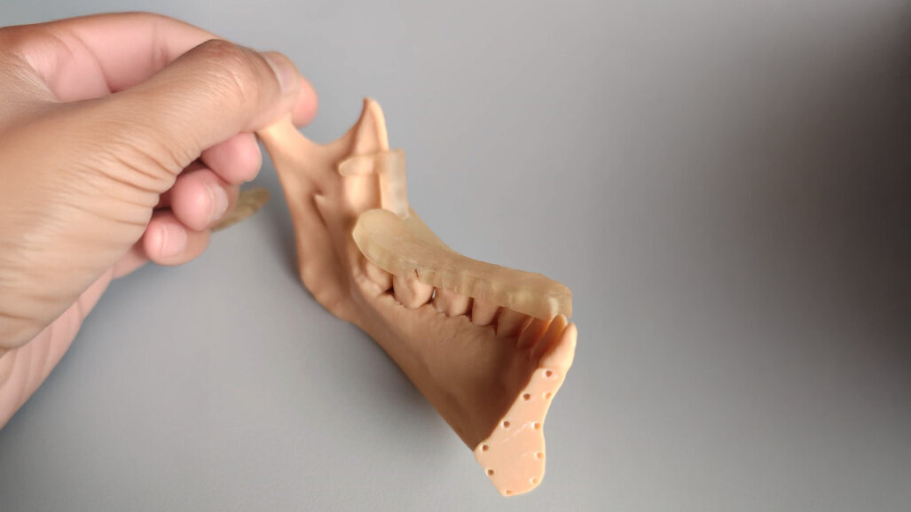 The advantages of digital planning and surgery-first for a better and predictable result in orthognathic surgery