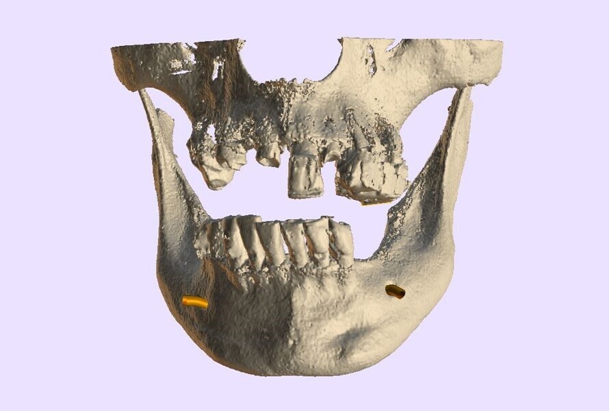 Fig. 6a: 3D volumetric reconstruction of the maxilla and mandible.