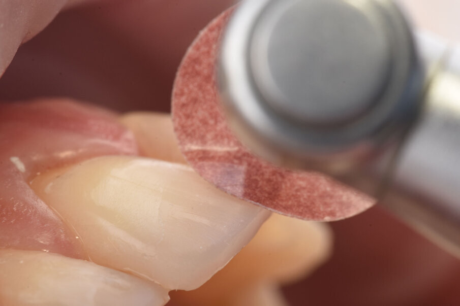 Sl. 16: Završna obrada i poliranje restauracije