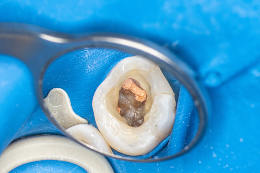 Fig. 21: The pulp chamber of the first molar with filled canals.