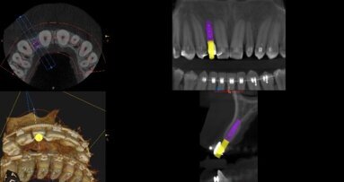 Wirtualne planowanie leczenia implantoprotetycznego – opis przypadków