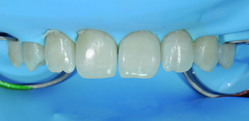 Fig. 5 : a) Après la mise en place de la digue en caoutchouc. 