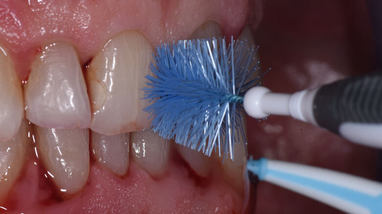 L'efficacia del controllo del biofilm batterico: quali livelli di attenzione?