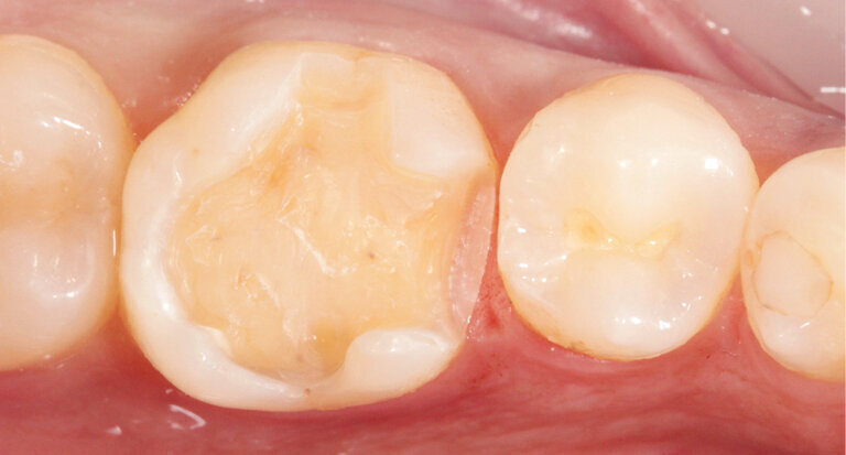 Fig. 2: Prepared tooth