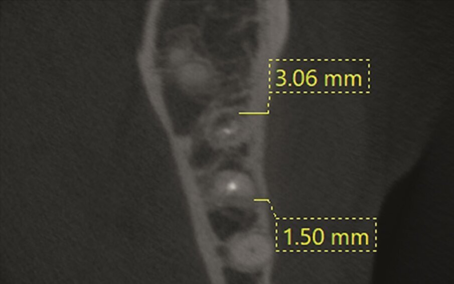 Fig. 1a–d: Pre-op CBCT scan of tooth #36. The axial (a), …
