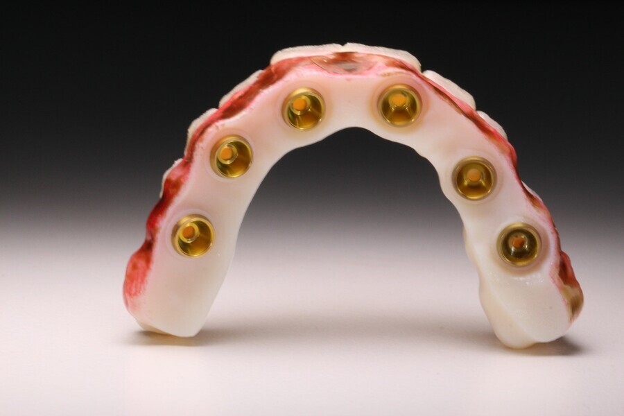 Fig. 16: Cementation of the Elos Accurate Hybrid Base H Non-Engaging bases with PANAVIA V5 and CLEARFIL CERAMIC PRIMER PLUS.