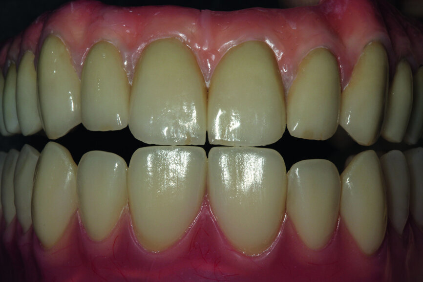 Fig. 22: Comparison of the pattern, that is, the temporary prosthesis and the final prosthetic work.