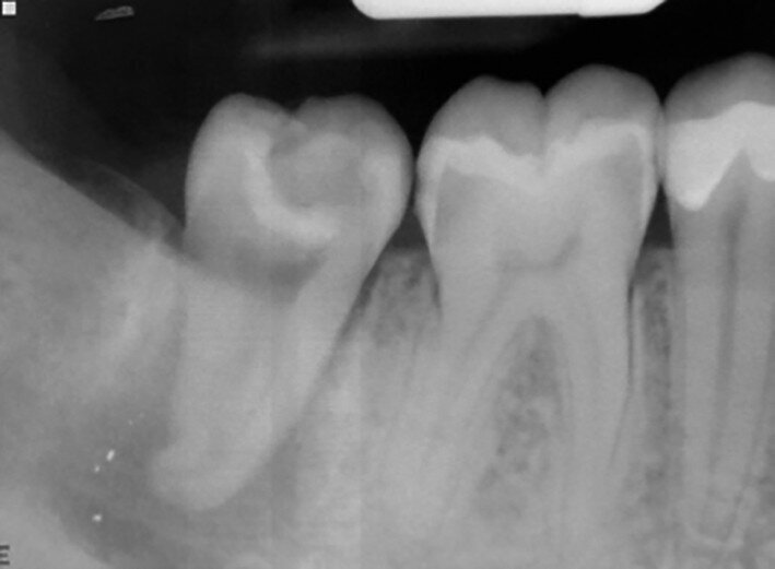 Fig. 18b: Radiographs: Immediately after transplantation.