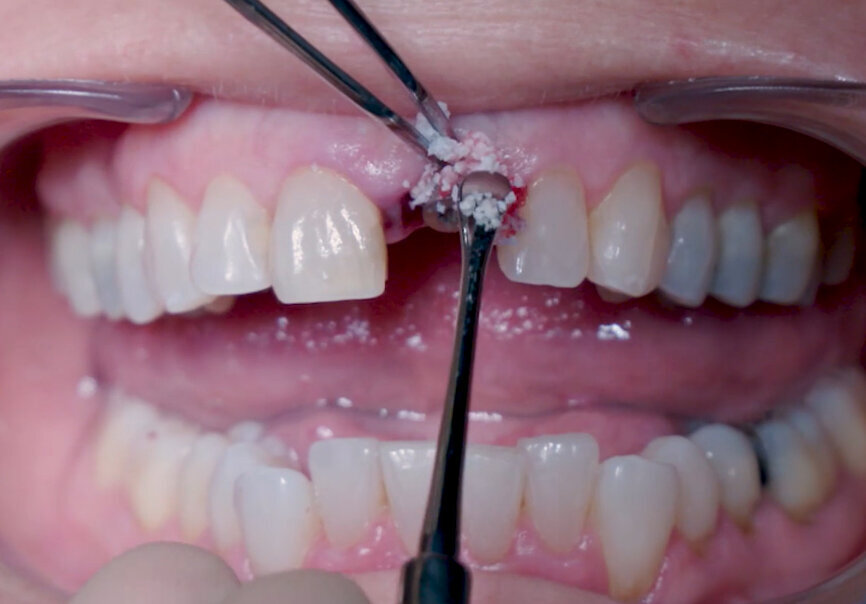 Fig. 15: Straumann XenoFlex being applied in labial gap.