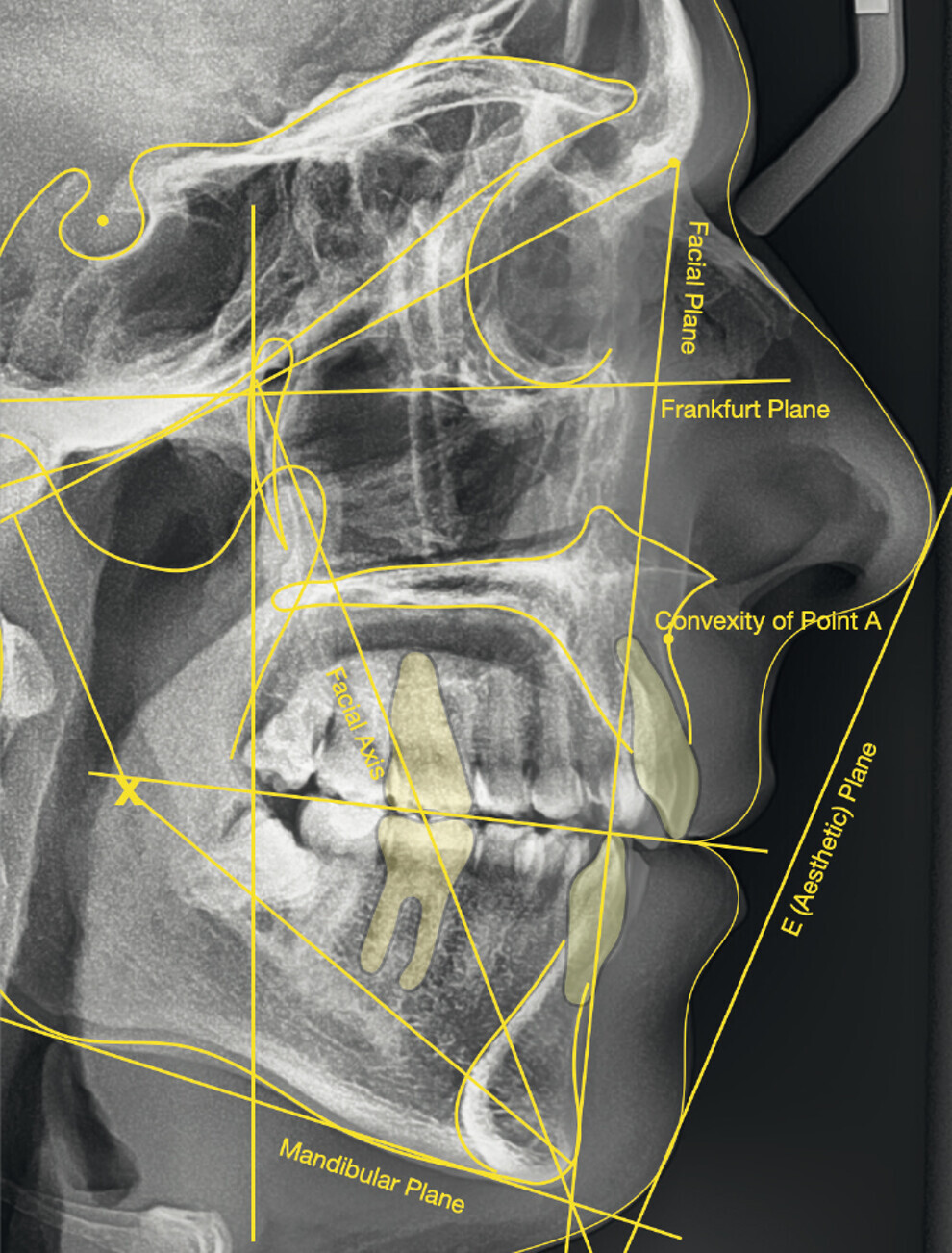 Fig. 9: Pretreatment lateral cephalometric radiograph.