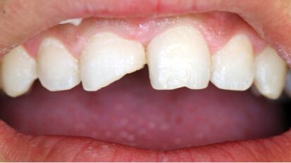 Nanohybridní kompozitní materiály: nejnovější třída kompozitních pryskyřic