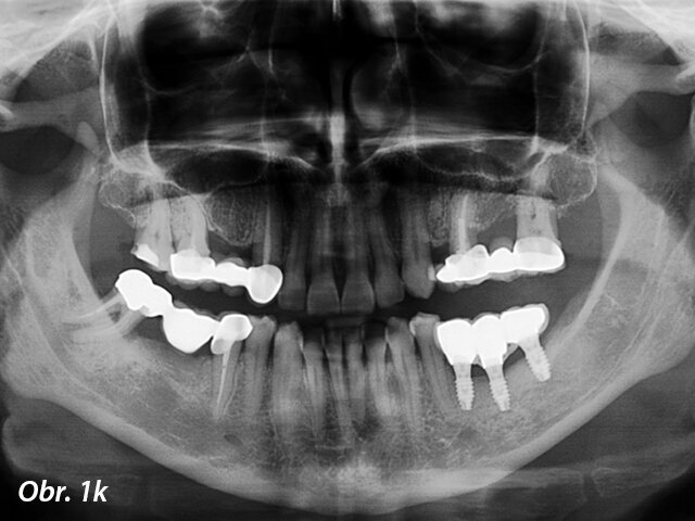Panoramatický rentgenový snímek jeden rok od zatížení