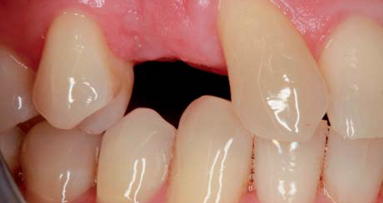 Tratamiento en una visita con CAD/CAM y CBCT