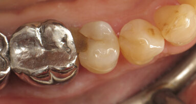 Class II restoration with thermo-viscous composite