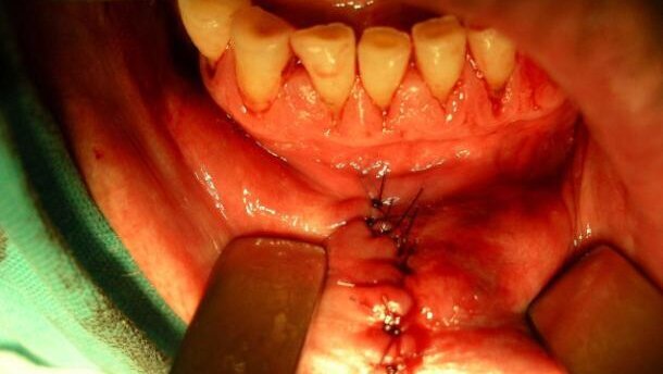 Wczesna diagnostyka i leczenie raka wargi dolnej – opis przypadku