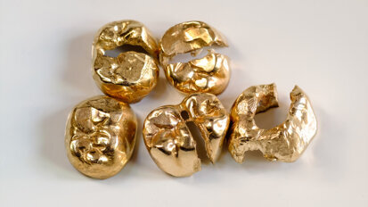 Zum Welttag des Sehens rufen Schweizer zu Zahngoldspenden für Augenoperationen auf