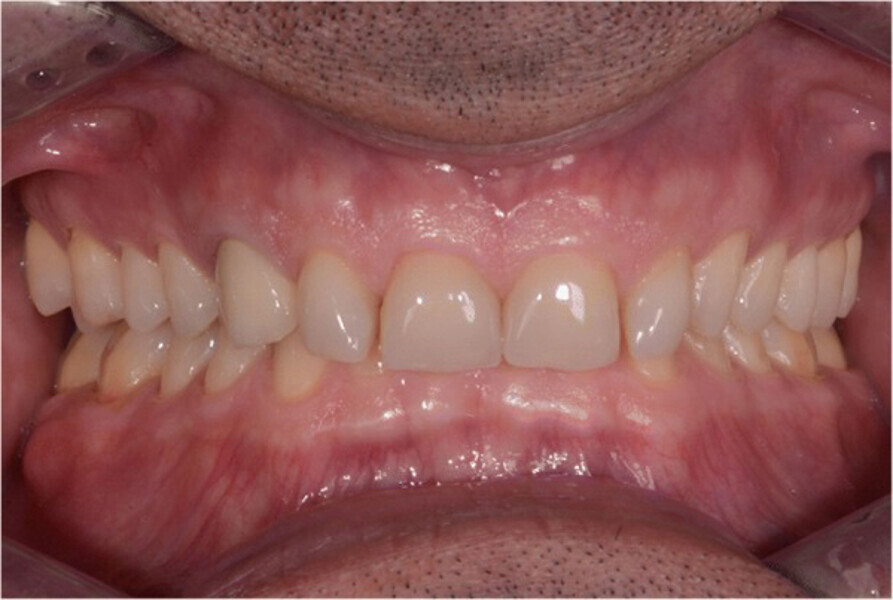 Fig.7. Dos años después, antes del tratamiento (2017).