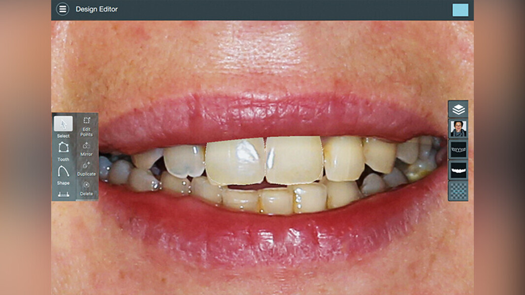 Fig. 2. Se simularon selectivamente los incisivos centrales ideales usando el software Smile Designer Pro.