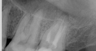 Évaluation complète d’un traitement de canal radiculaire supérieur