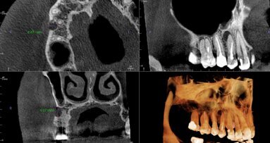 Dane CBCT mogą pomóc w stworzeniu zindywidualizowanych modeli 3D stosowanych do regeneracji tkanki przyzębia