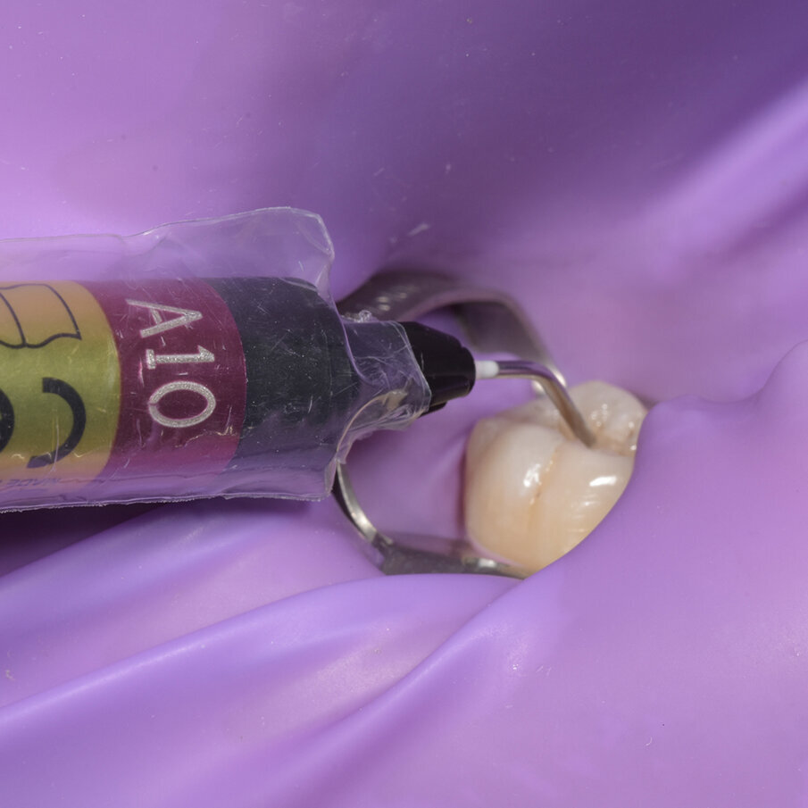 Fig 7: Replacing deep dentin layer with bioactive Beautifil Injectable X shade A10 