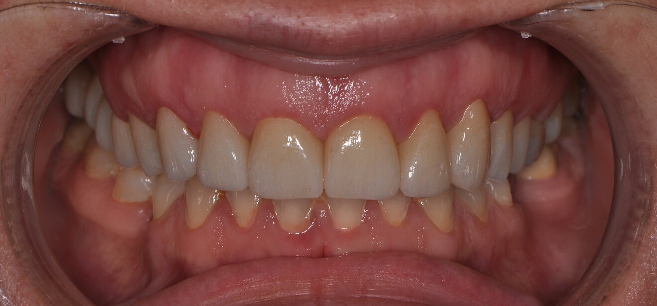 Fig. 5b: Final outcome after completion of treatment. Intra-oral view showing improved aesthetics and harmonised gingival contours.