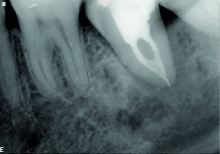 Fig. 15c: Radiograph: One-year recall.